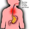 Barrett's Esophagus